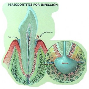 periodontitis periodontitis 300x300 ¿Cómo tratar la piorrea con homeopatía?