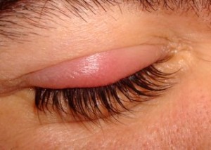 orzuelo orzuelo 300x214 ¿Cómo acabar con los orzuelos con homeopatía?